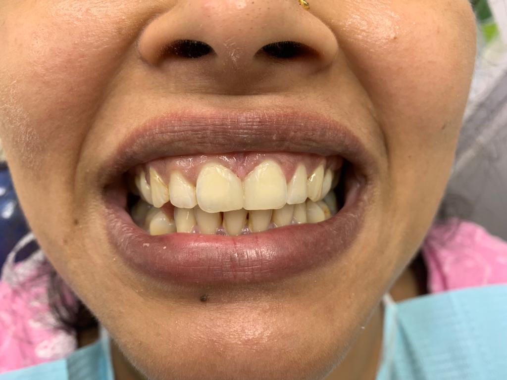 Aesthetic Space Closure after treatment